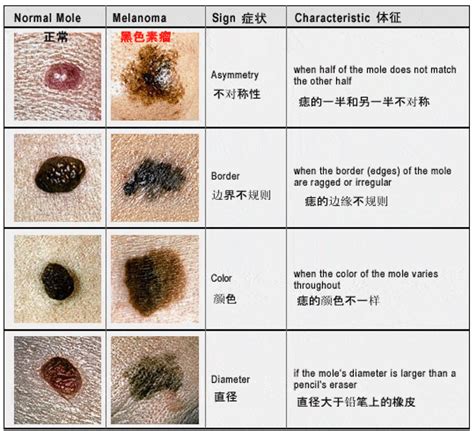 胸有大痣|痣也可能会癌变！长在 3 个地方要注意